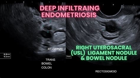 deep infiltrating endometriosis nhs